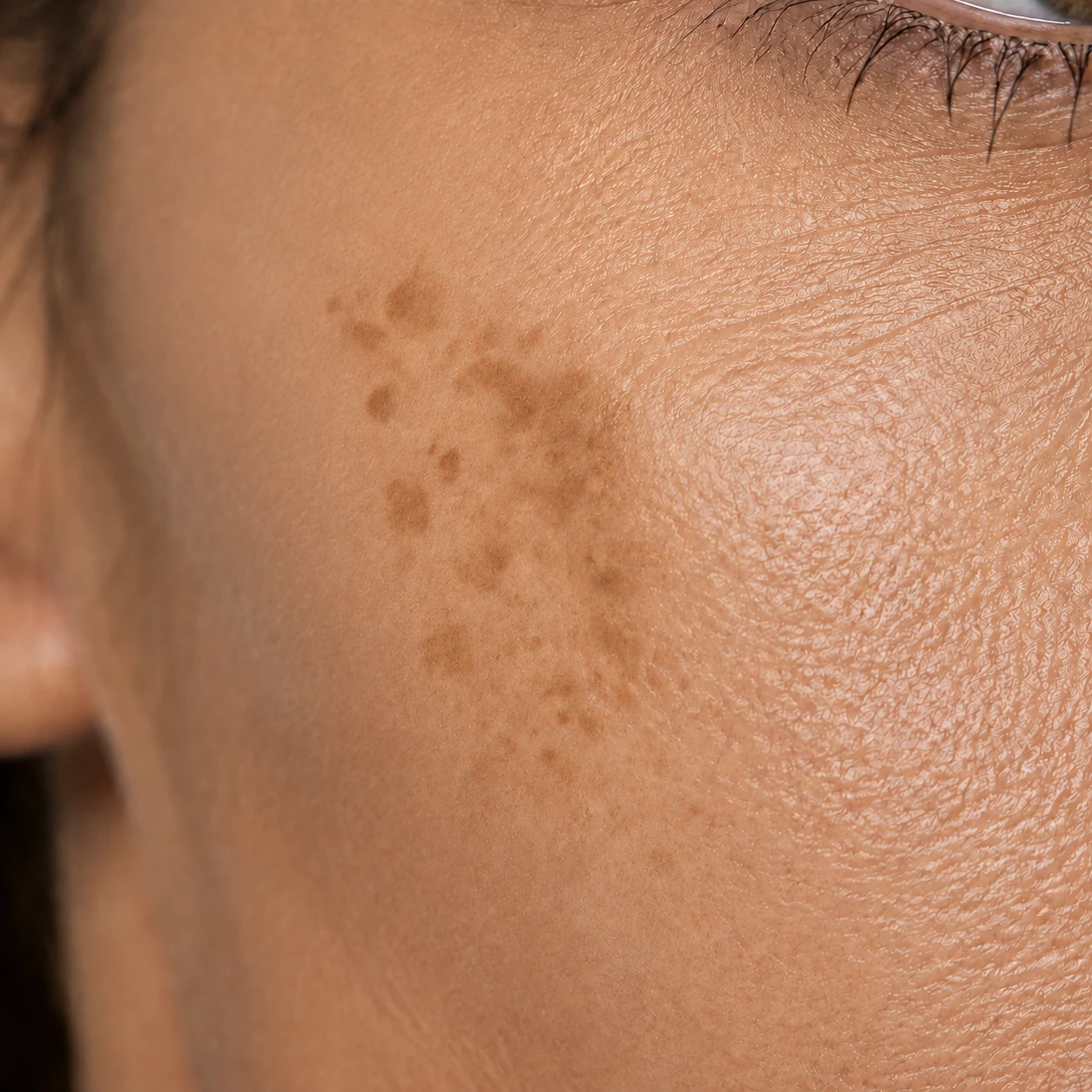 Illustrative cheekbone close-up with flat brown spots and a softly edged patch of uneven pigment. Not a client result.