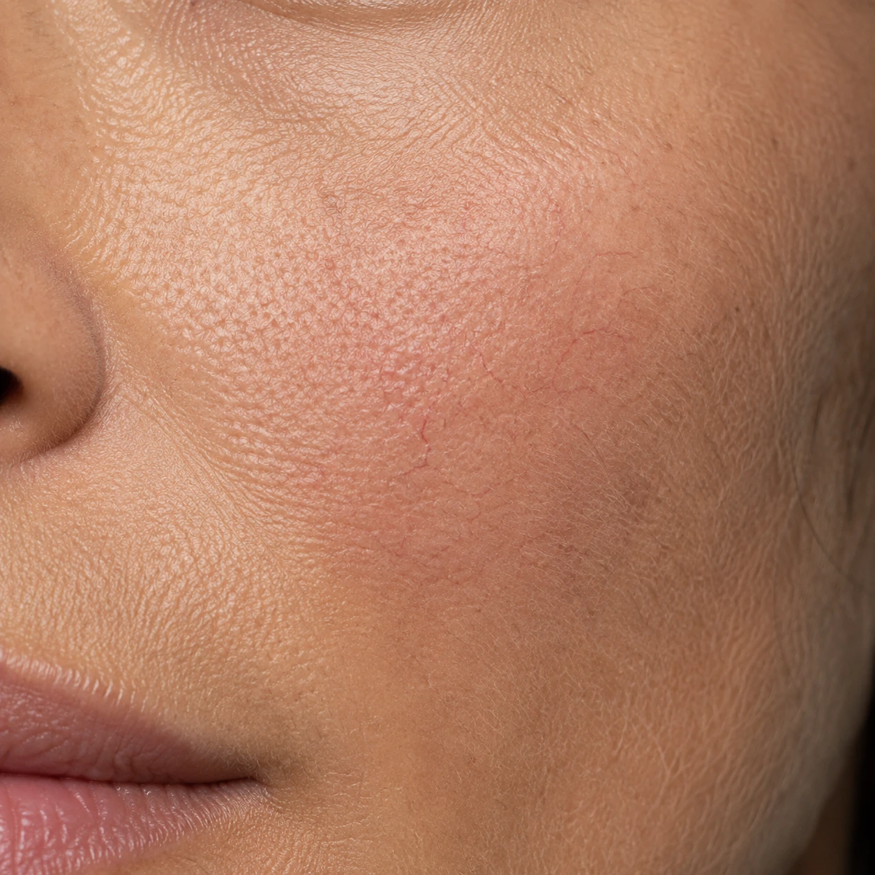 Illustrative outer-cheek close-up with diffuse pink-red flushing and fine visible vessels. Not a client result.